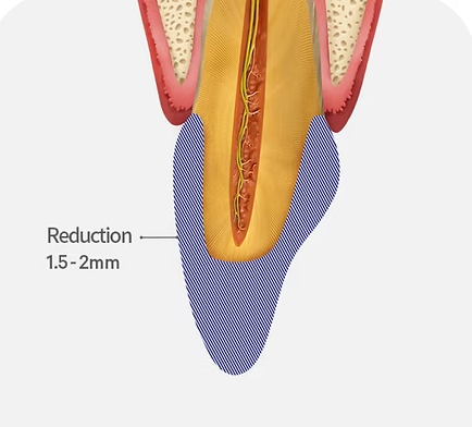 Diagram of tooth preparation for a dental crown