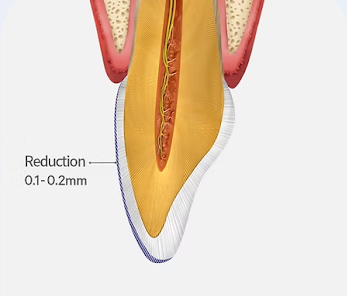 Diagram of MINISH veneer preparation, with surface polishing or minimal enamel reduction