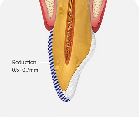 Diagram of conventional porcelain veneer preparation and enamel reduction